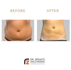 Liposuzione - Dott. Renato Zaccheddu
