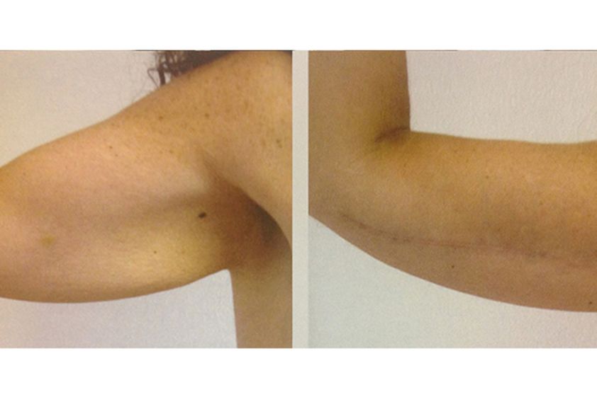 Liposcultura prima e dopo - 751170