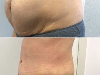 Addominoplastica prima e dopo - 879435