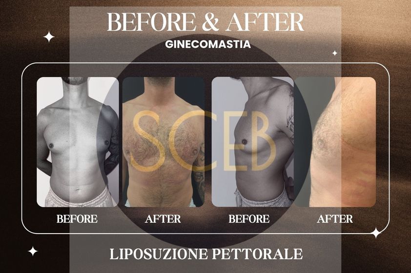 Ginecomastia prima e dopo - 879532