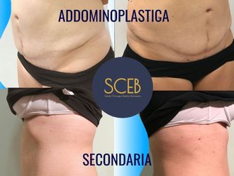 Addominoplastica prima e dopo - 880306