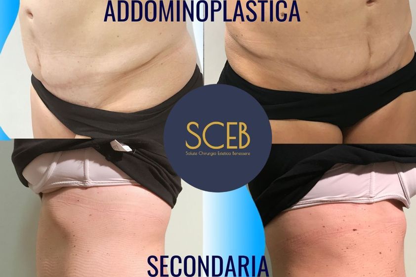 Addominoplastica prima e dopo - 880306