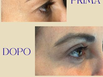 Blefaroplastica prima e dopo - 880335
