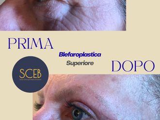 Blefaroplastica prima e dopo - 880336