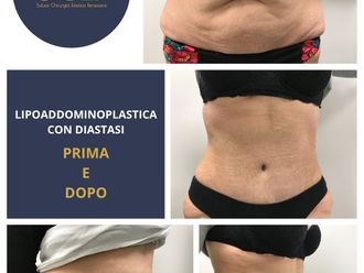 Addominoplastica prima e dopo - 880358