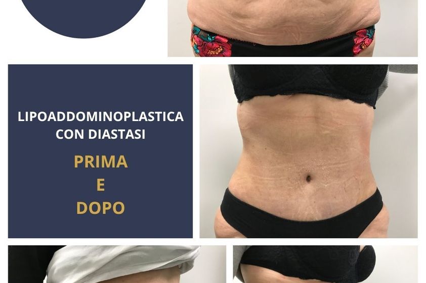 Addominoplastica prima e dopo - 880358