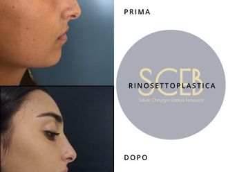 Rinoplastica prima e dopo - 880528