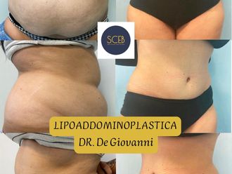 Liposuzione prima e dopo - 880542