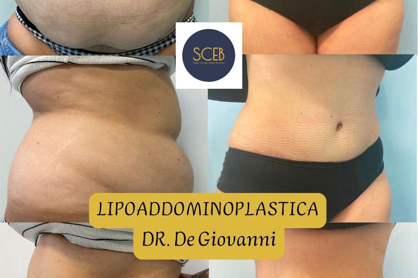Liposuzione prima e dopo - 880542