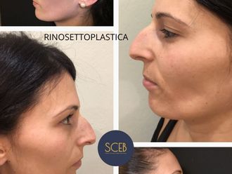 Rinoplastica prima e dopo - 880557