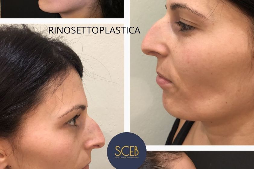 Rinoplastica prima e dopo - 880557