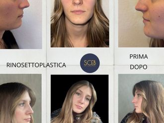 Rinoplastica prima e dopo - 880566