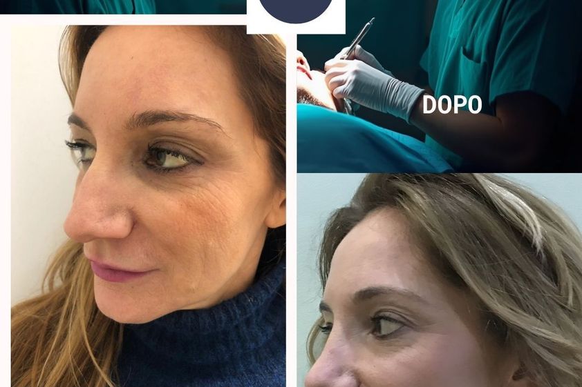 Rinoplastica prima e dopo - 880576