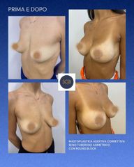 MASTOPLASTICA ADDITIVA CORRETTIVA  SENO TUBEROSO ASIMETRICO CON ROUND BLOCK - Dott. Manuel De Giovan
