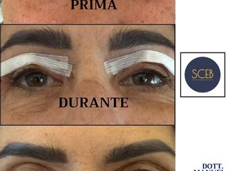 Blefaroplastica prima e dopo - 880620