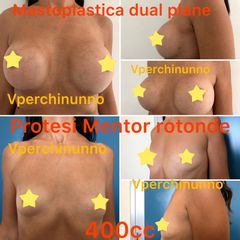 Mastoplastica additiva prima e dopo