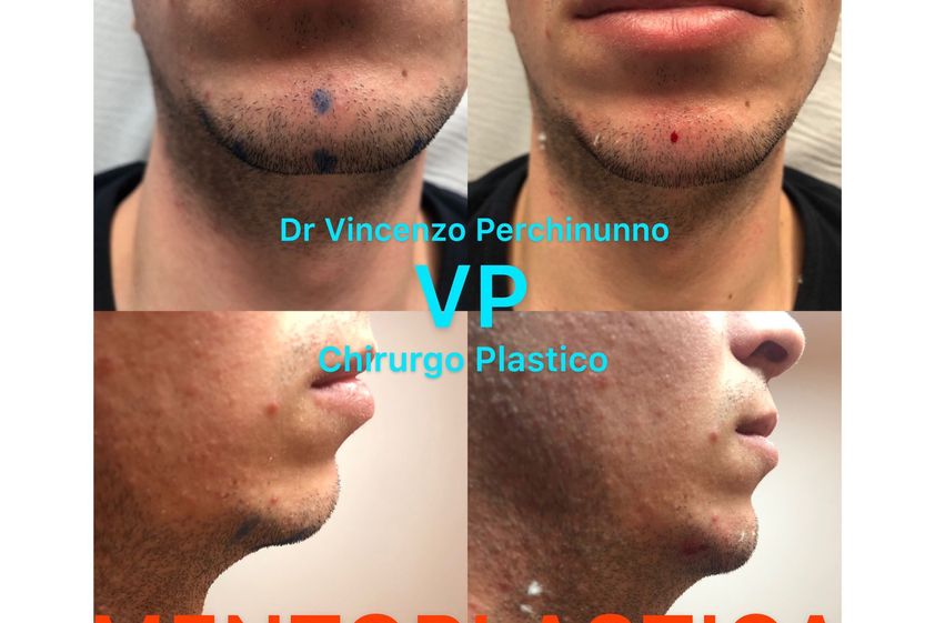 Mentoplastica prima e dopo - 790038