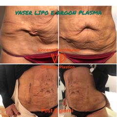 Liposuzione - Dott. Vincenzo Perchinunno
