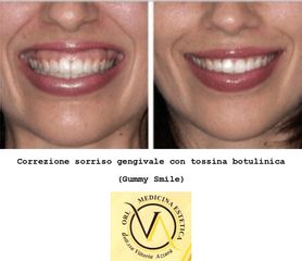 Sorriso gengivale con tossina botulinica - Dott.ssa Vittoria Azzarà
