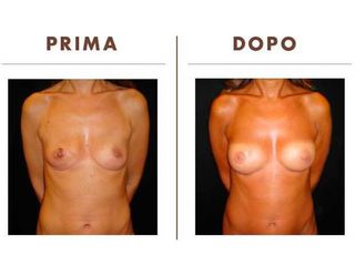 Mastoplastica additiva prima e dopo