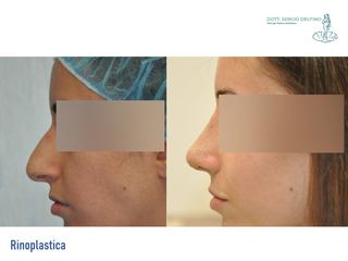 Rinoplastica prima e dopo