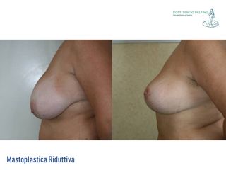 Mastoplastica riduttiva prima e dopo