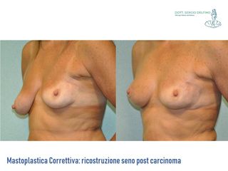 Ricostruzione del seno prima e dopo