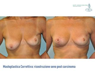 Ricostruzione del seno prima e dopo