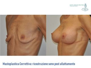 Ricostruzione del seno prima e dopo