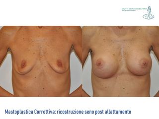 Ricostruzione del seno prima e dopo