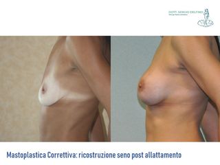 Ricostruzione del seno prima e dopo