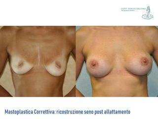 Ricostruzione del seno prima e dopo