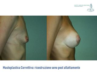 Ricostruzione del seno prima e dopo