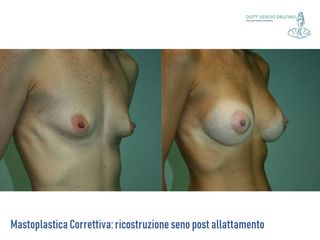 Ricostruzione del seno prima e dopo