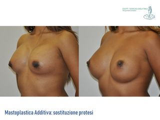Sostituzione protesi prima e dopo