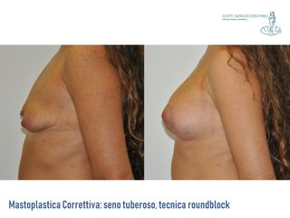 Mastoplastica additiva prima e dopo