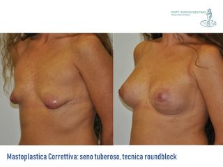 Mastoplastica correttiva prima e dopo