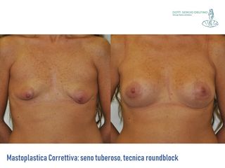 Mastoplastica correttiva prima e dopo