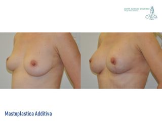 Mastoplastica additiva prima e dopo