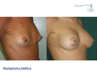 Mastoplastica additiva prima e dopo