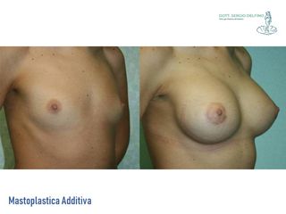 Mastoplastica additiva prima e dopo