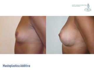 Mastoplastica additiva prima e dopo