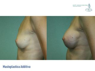 Mastoplastica additiva prima e dopo