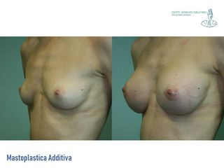 Mastoplastica additiva prima e dopo