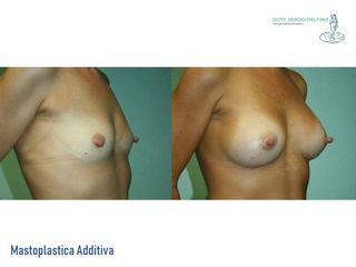 Mastoplastica additiva prima e dopo