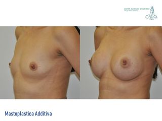 Mastoplastica additiva prima e dopo