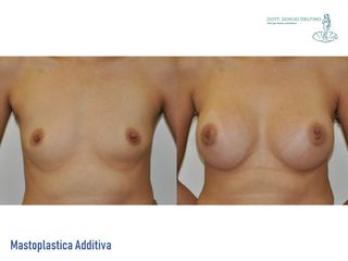 Mastoplastica additiva prima e dopo