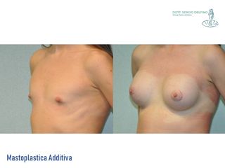 Mastoplastica additiva prima e dopo