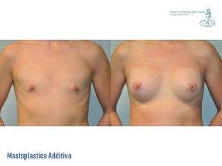 Mastoplastica additiva prima e dopo