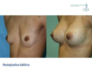 Mastoplastica additiva